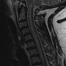 Anterior Spinal Artery Syndrome | American Journal of Neuroradiology