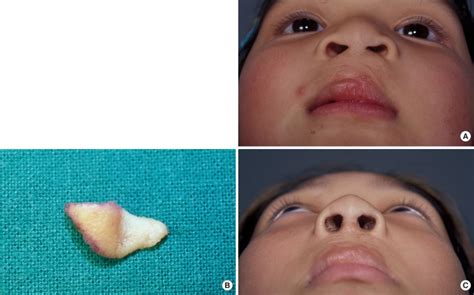 A 5 Year Old Girl With A Bilateral Cleft Lip Nasal Deformity With A