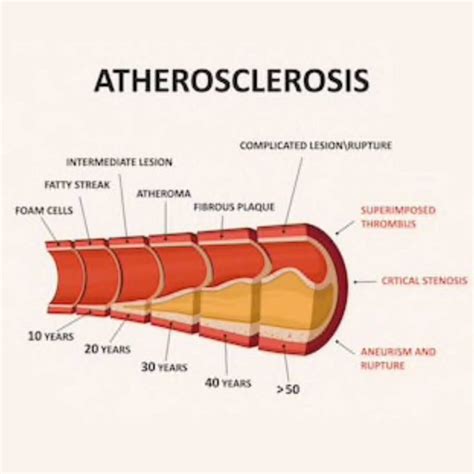 Coronary Heart Disease | 12 risk factors & how to alter it