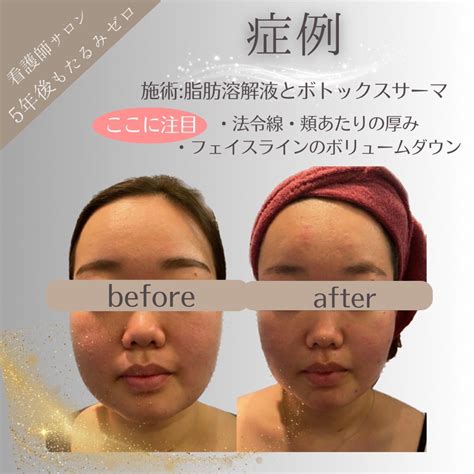 脂肪溶解でリバウンド知らずのお顔に！ 【hifu専門】看護師クリニカルサロンclinicalbeauteのブログ