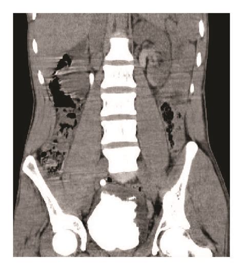 Abdominopelvic Ct Scan Of Patient A Axial View Showing Bilateral