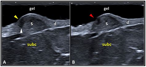 From Histopathology to High-Resolution Ultrasound Imaging of Skin Scars
