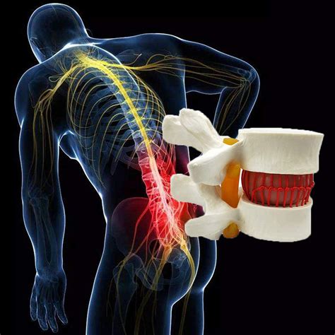 Buy Study Model Human Lumbar Disc Herniation Demonstration Model Human