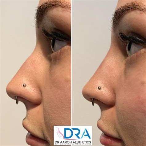 Non Surgical Rhinoplasty Purpose To Hide Bumps Straighten Your Nose