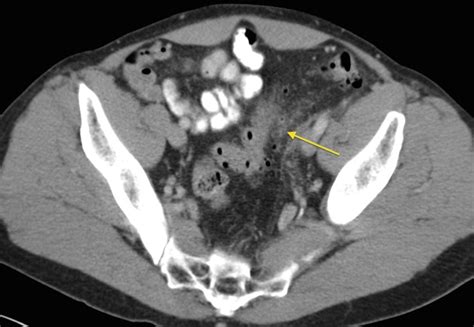 Acute Diverticulitis Radiology At St Vincents University Hospital