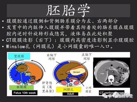 胃肠穿孔：气从哪里来？通过腹膜解剖确定穿孔部位 知乎