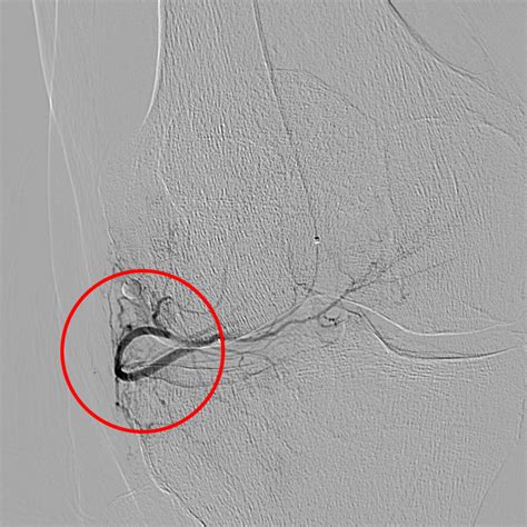 Geniculate Artery Embolization GAE