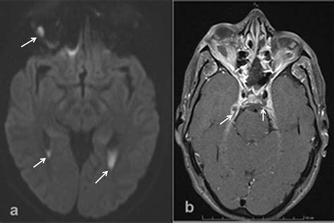 (A) Diffusion weighted imaging slide showing areas of restricted ...