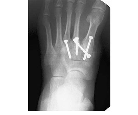 Screw Fixation For A Lisfranc Injury Download Scientific Diagram