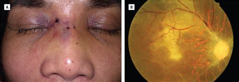 Sudden Bilateral Vision Loss And Brain Infarction Following Cosmetic Hyaluronic Acid Injection