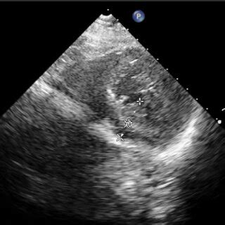 Echocardiographic Findings At Year Follow Up Short Axis View Showing