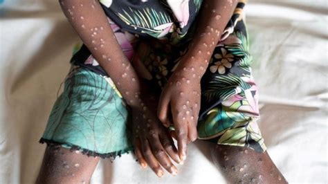 Mpox Outbreak Claims Lives In Dr Congo