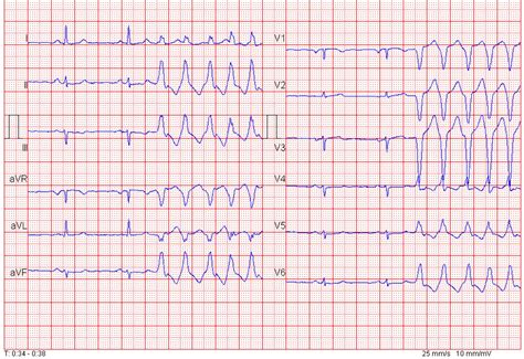 Polymorphic Ventricular Tachycardia Ecg