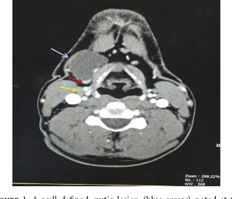 Figure From Papillary Thyroid Carcinoma As A Lateral Neck Cyst A