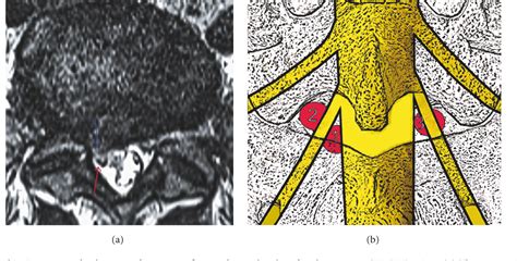 Figure From The Early Clinical Outcomes Of A Percutaneous Full