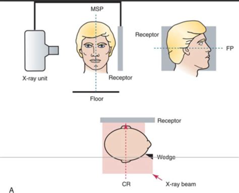 OHS Radiology W8 Extraoral Techniques Flashcards Quizlet