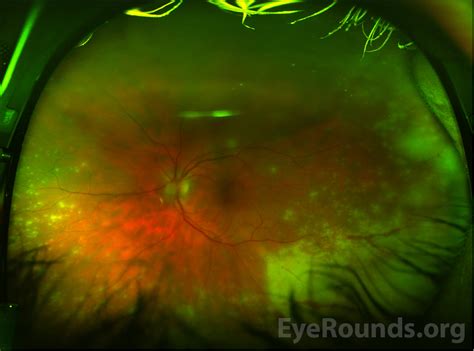 Eyerounds Org Bilateral Acute Retinal Necrosis