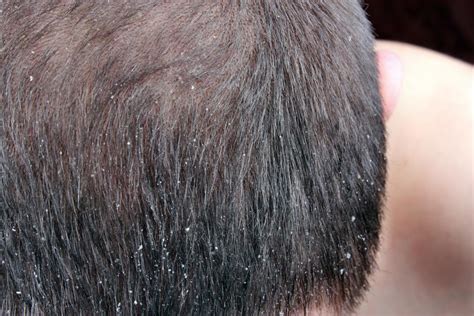 Scalp Psoriasis Vs Dandruff: Symptoms, Pictures, And Causes, 50% OFF