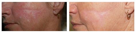 Fractionated Laser Rejuvenation Cosmetic Elegance