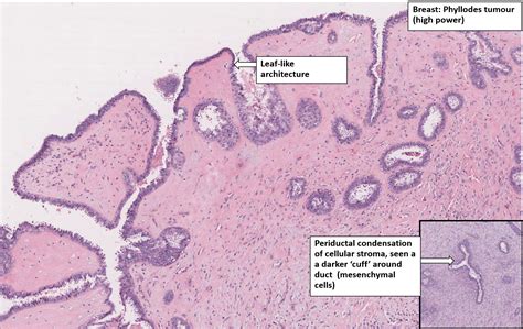 Breast Phyllodes Tumour Nus Pathweb Nus Pathweb