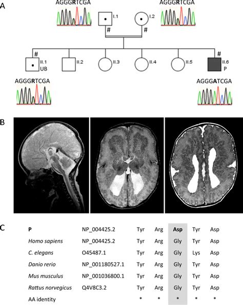 A Novel Missense Variant In The Eml Gene Associated With Bilateral