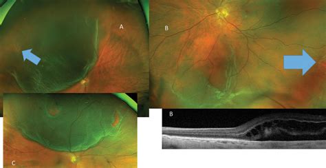 A Field Guide To Retinal Holes And Tears