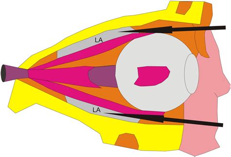 Regional Anesthesia Of The Eye Orbit And Periocular Skin Clinics In