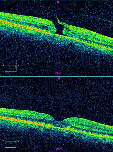 Macular hole repair : r/optometry