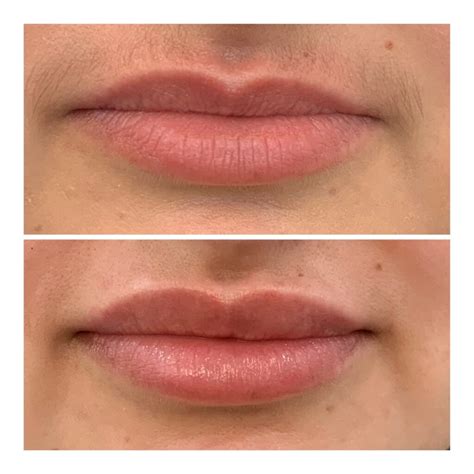 Understanding Lip Filler Costs In Winnipeg What Factors Influence