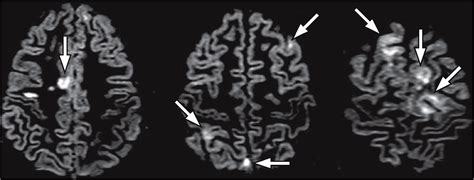 Measurement And Clinical Effect Of Grey Matter Pathology In Multiple Sclerosis The Lancet