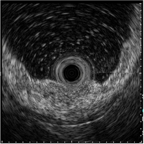 Eus Detected A Thick Low Echoic Lesion In The Second Layer Of The Download Scientific Diagram