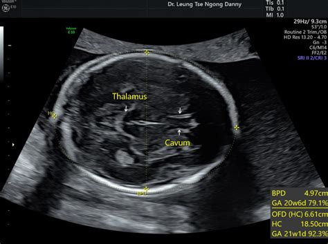 Fetal biometry - HKOG-INFO