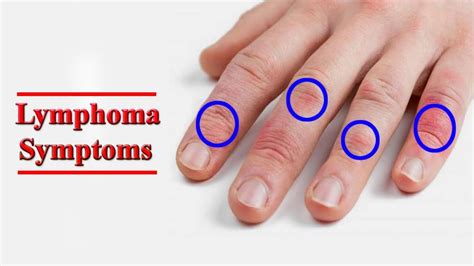 Lymphoma - Types, Causes, Symptoms, Diagnosis, Treatment