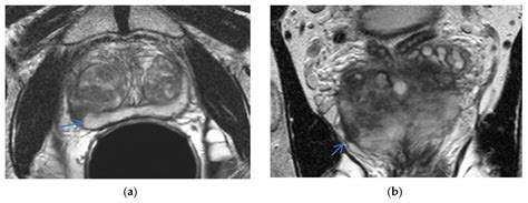 Life Free Full Text Prostate Mri Is Endorectal Coil Necessary—a Review