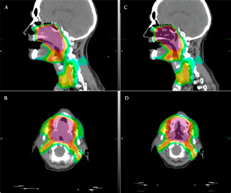 Figure 1 From Magnetic Resonance Guided Radiotherapy For Head And Neck