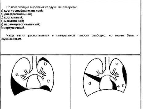 Плевриты Плеврит — это воспаление