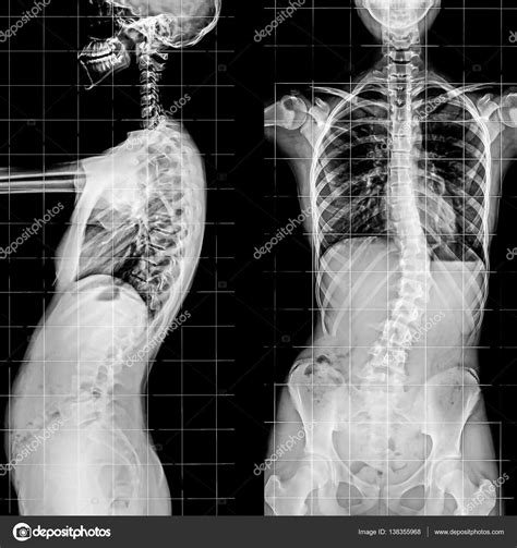 Coluna Vertebral Lateral Fotografias De Stock Sciencepics My XXX Hot Girl