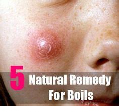 18 Best Boils on Face ideas | home remedies, remedies, natural remedies