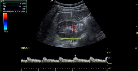 218 Protocolo Básico Ecografía Doppler Renal Ecografía Fácil