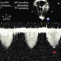 Echocardiography Showing A Decrease In The Pulmonary Artery Systolic