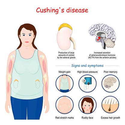 Cushings Disease Signs And Symptoms Of Cushing Syndrome Stock ...