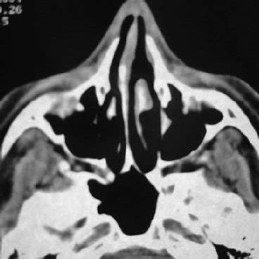 Preoperative CT scan: mucosal thickening in the sphenoethmoidal recess... | Download Scientific ...