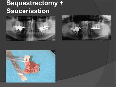 Osteomyelitis Of Jaws