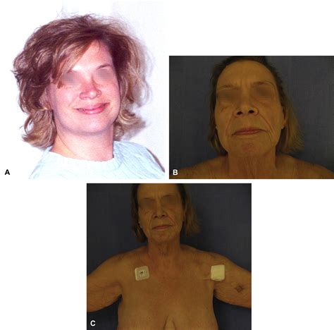 Acquired Cutis Laxa Associated With Heavy Chain Deposition Disease