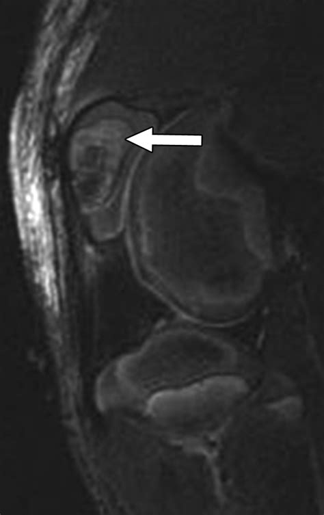 Bone Bruise Knee Mri