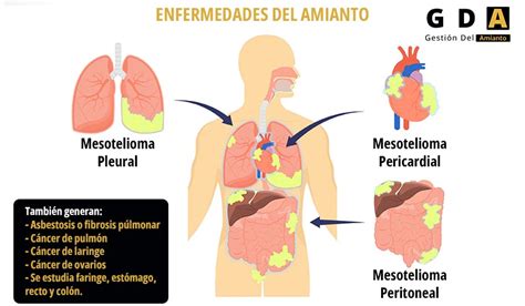 Síntomas De Exposición Al Asbesto