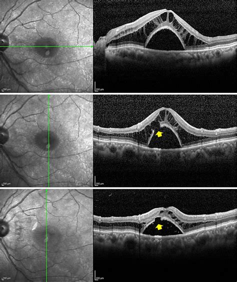 Figure 1 From Macular Structure Recovery After Surgery For Optic Disc