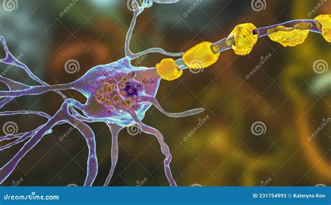 Neurônios Cerebrais Em Doenças De Armazenamento Lisossómico 3d