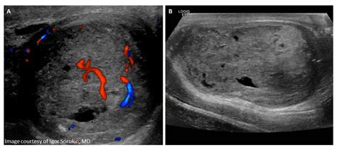 Testicular Rupture Ultrasound