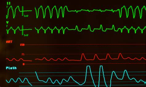 Herzrhythmusst Rungen Mit Bestrahlung Behandeln Kardiologie